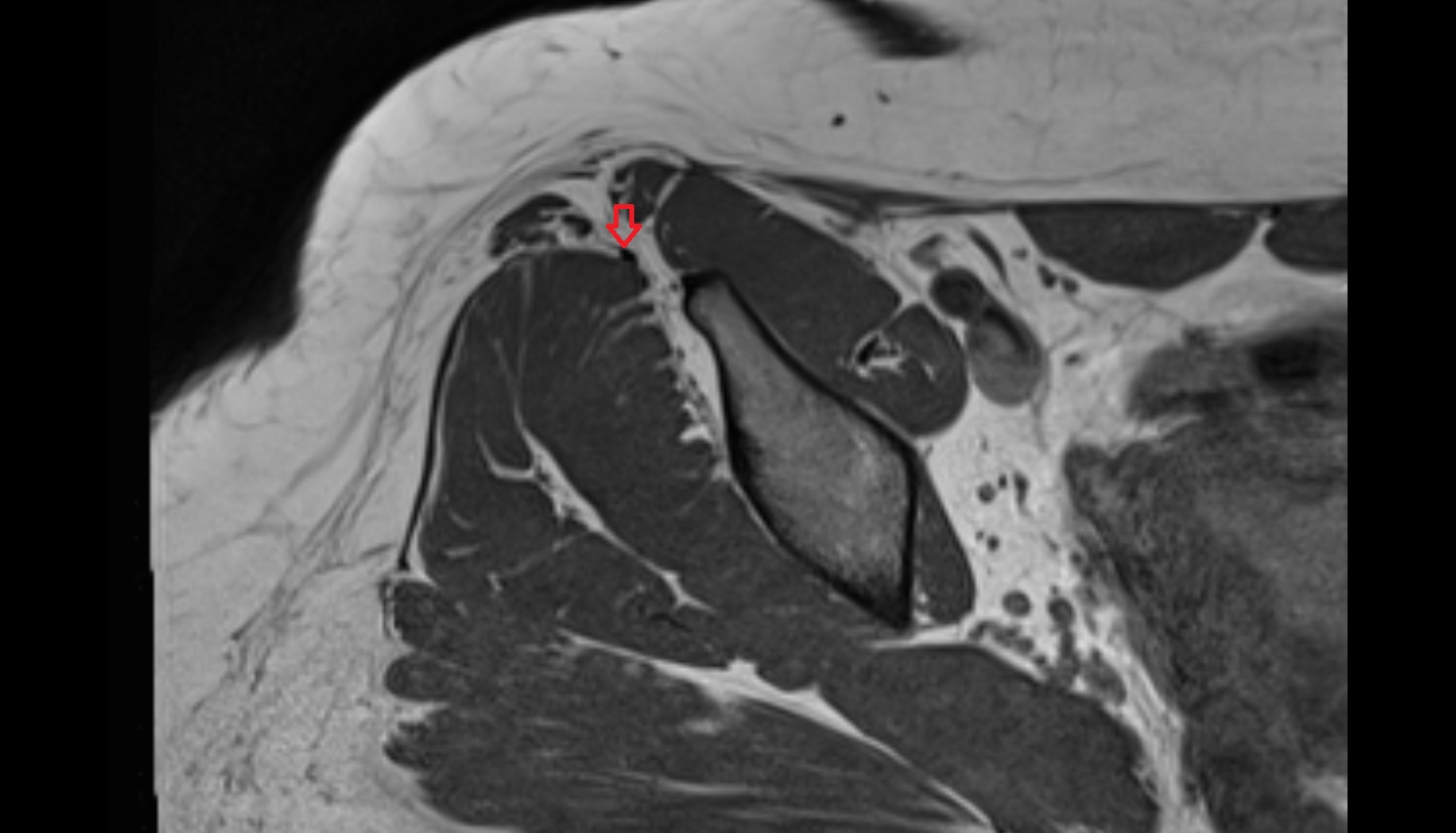 Tensor fasciae latae tendon  MRI axial anatomy image-img-00000-00000_00001