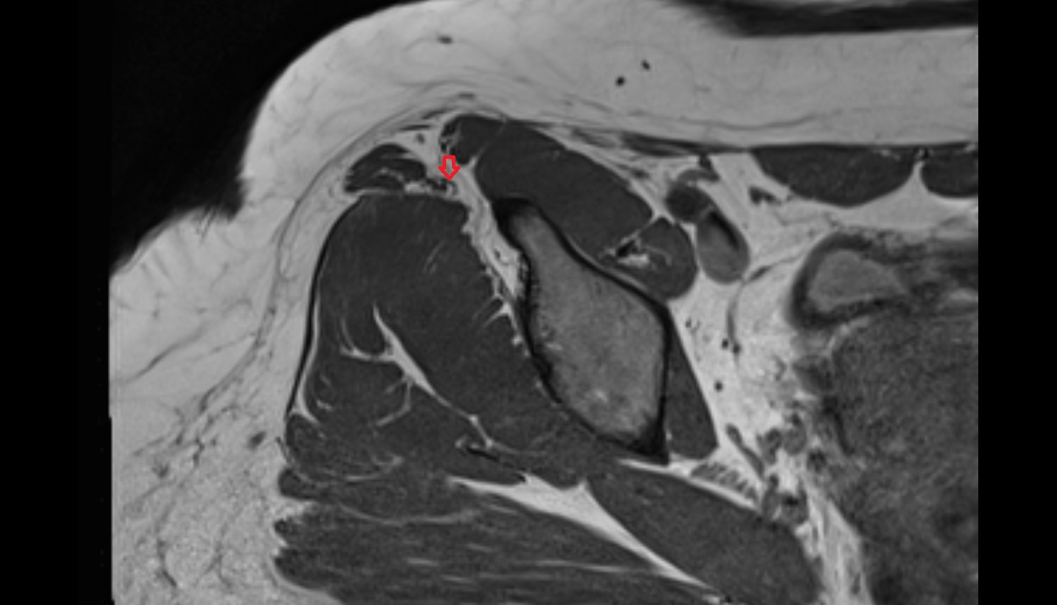 Tensor fasciae latae tendon  MRI axial anatomy image-img-00000-00000_00002