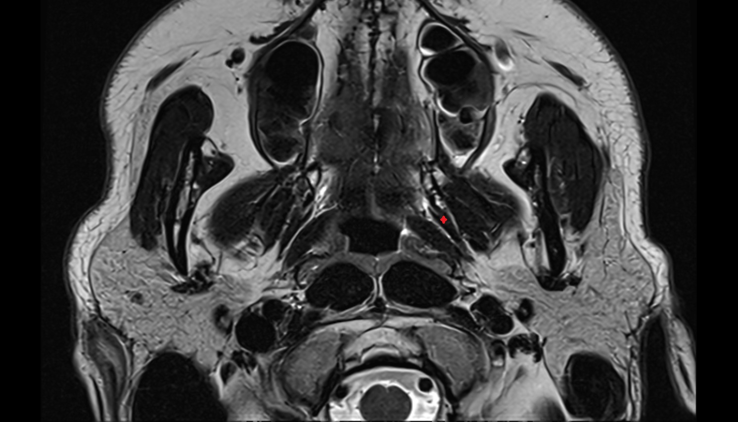 Tensor veli palatini muscle mri axial image -img-00000-00000