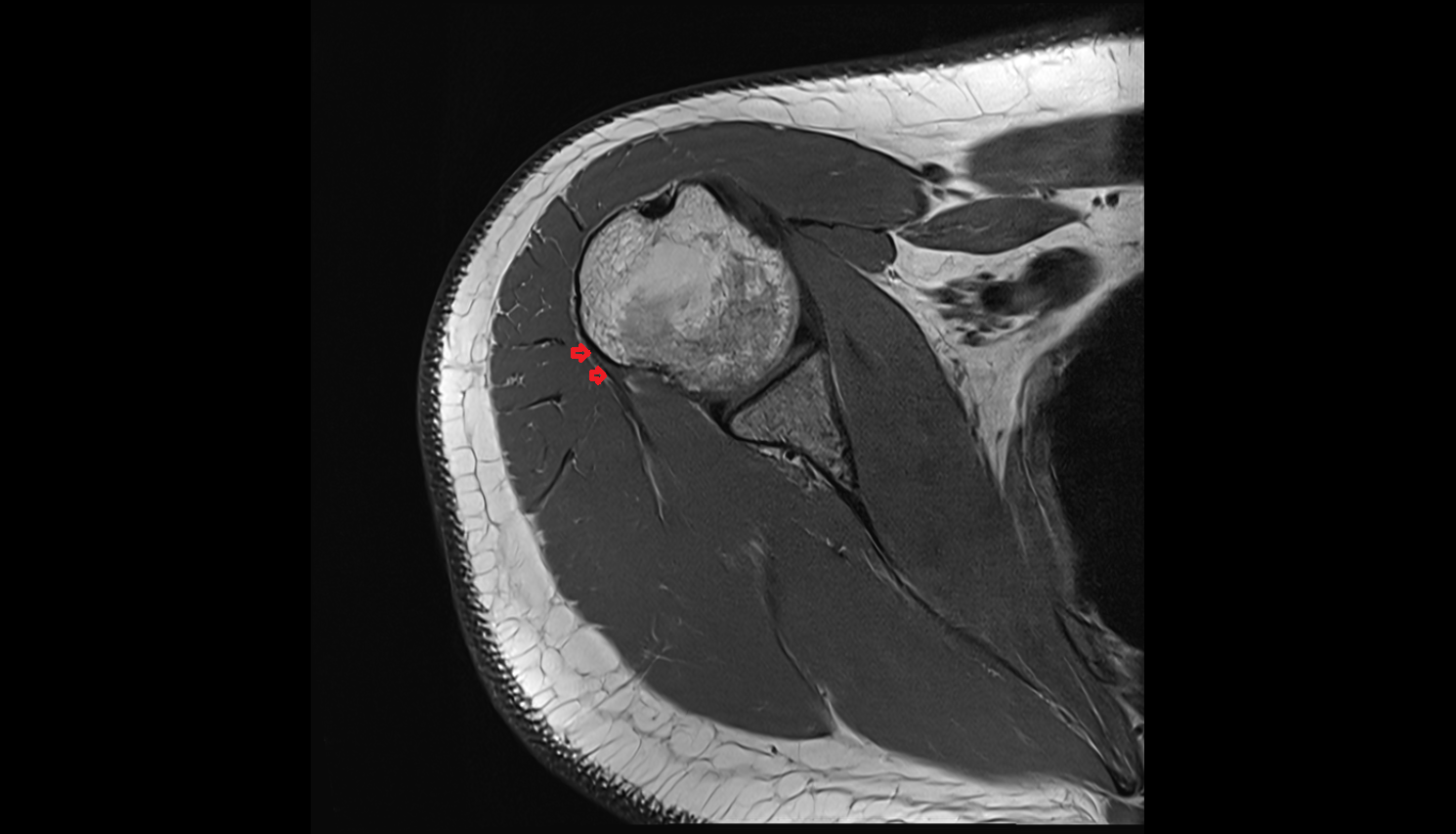 Teres Minor Tendon (distal) axial cross sectional anatomy 3T MRI AI enhanced radiology image-img-00000-00000
