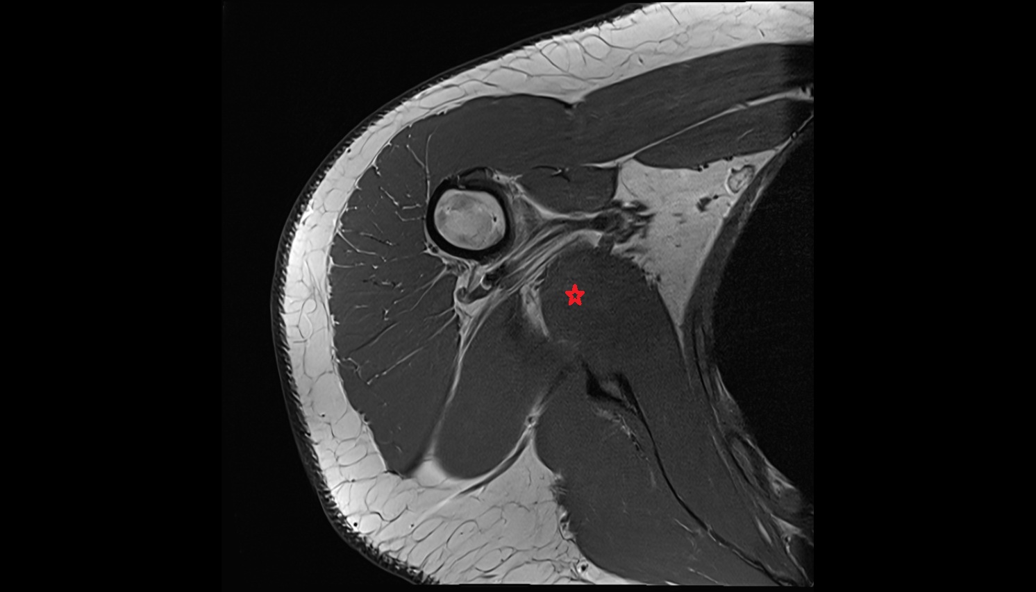 Teres major muscle  anatomy MRI axial  image -img-00000-00000