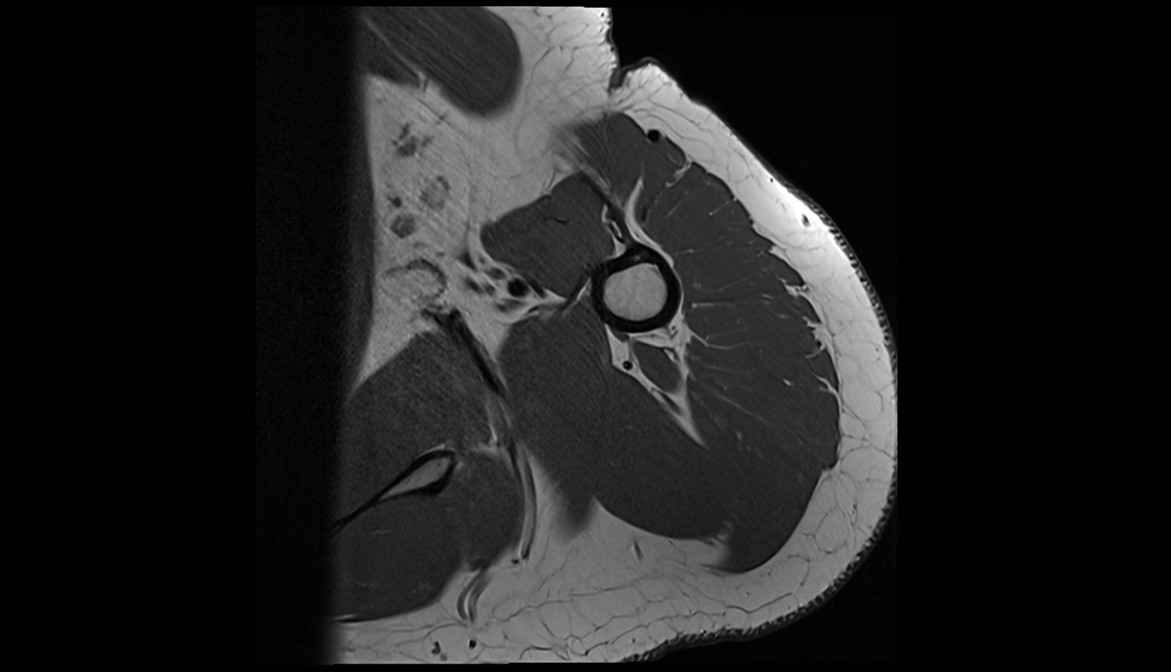 Teres major muscle mri axial image