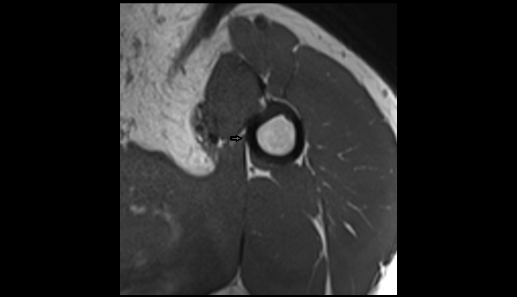 Teres major tendon mri 3d 1mm axial