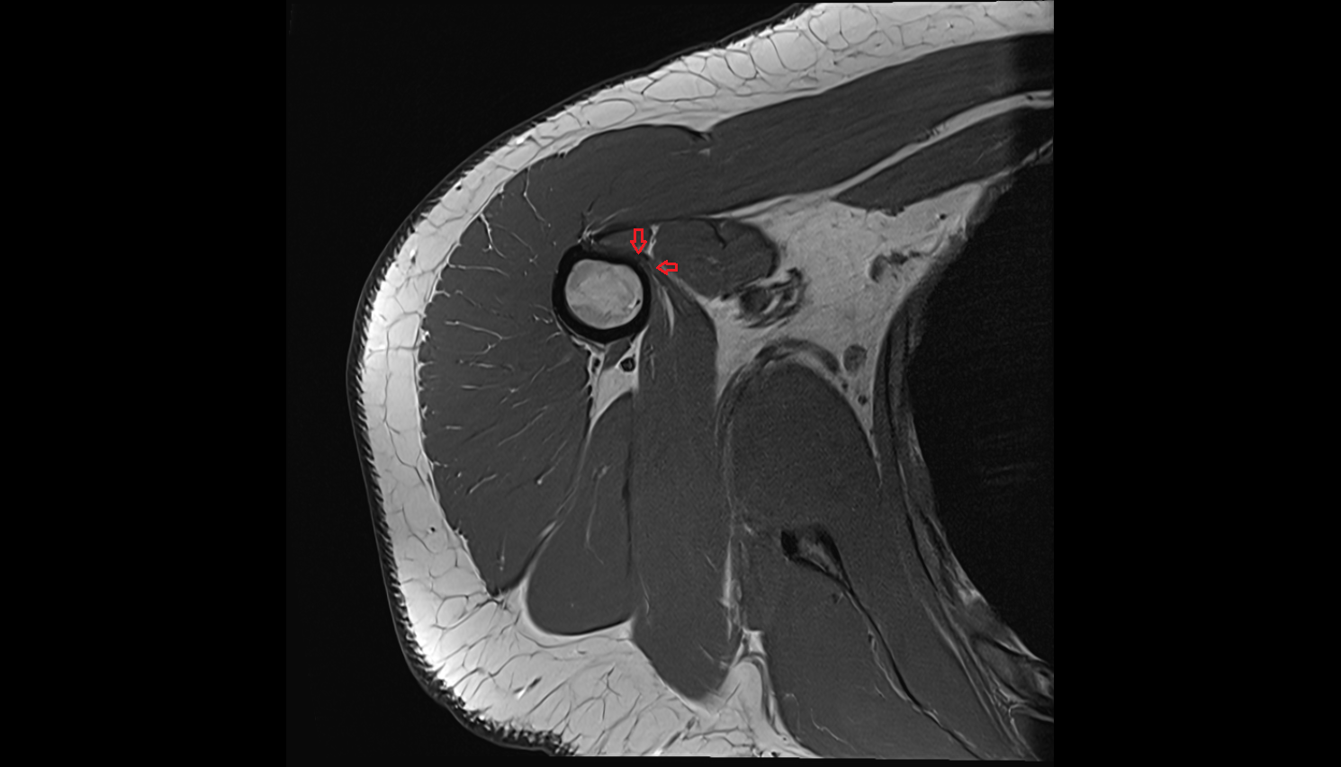 Teres major tendon  sag cross sectional anatomy 3T MRI AI enhanced radiology image-img-00000-00000