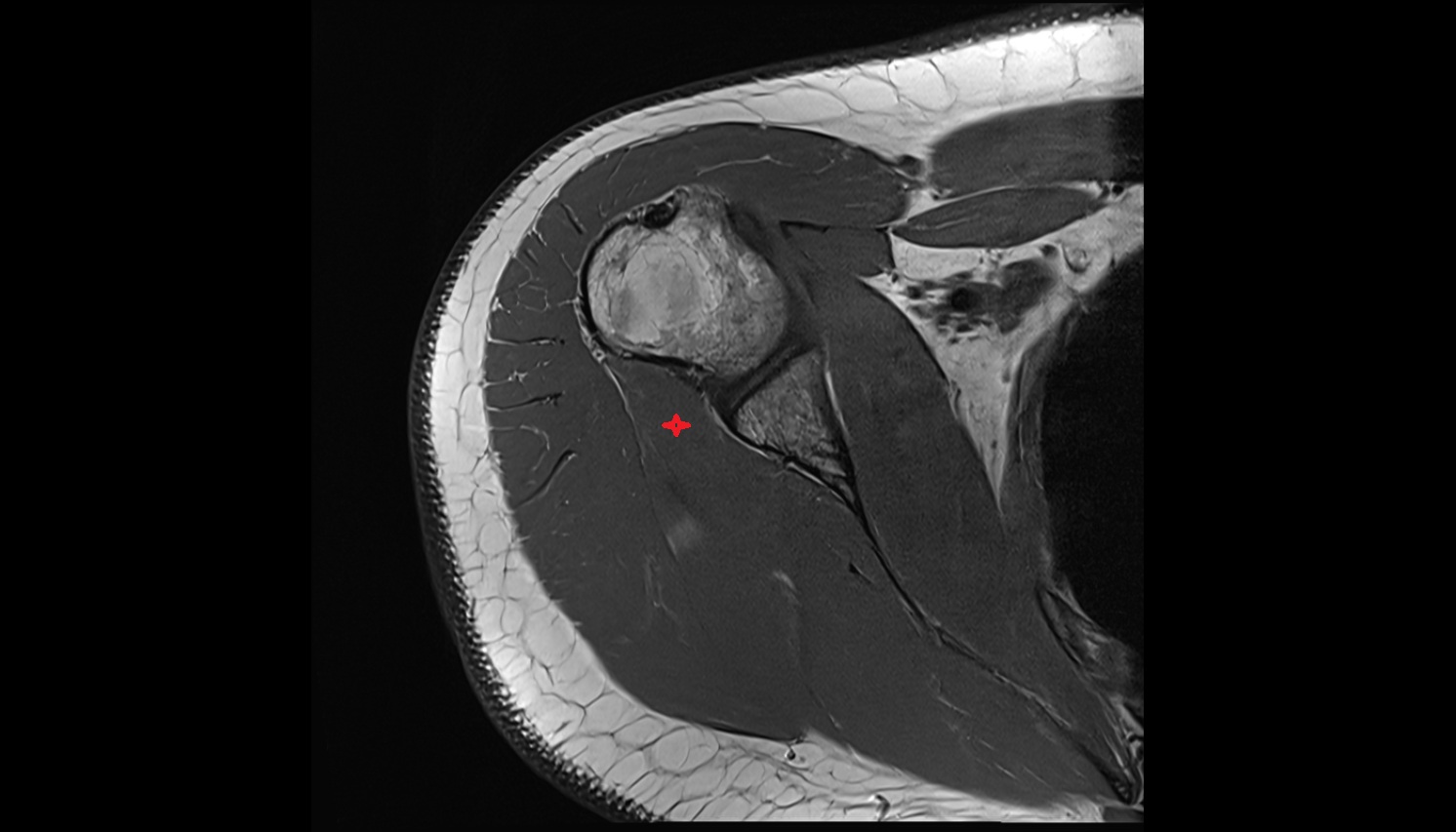 Teres minor muscle  anatomy MRI axial  image -img-00000-00000_00001