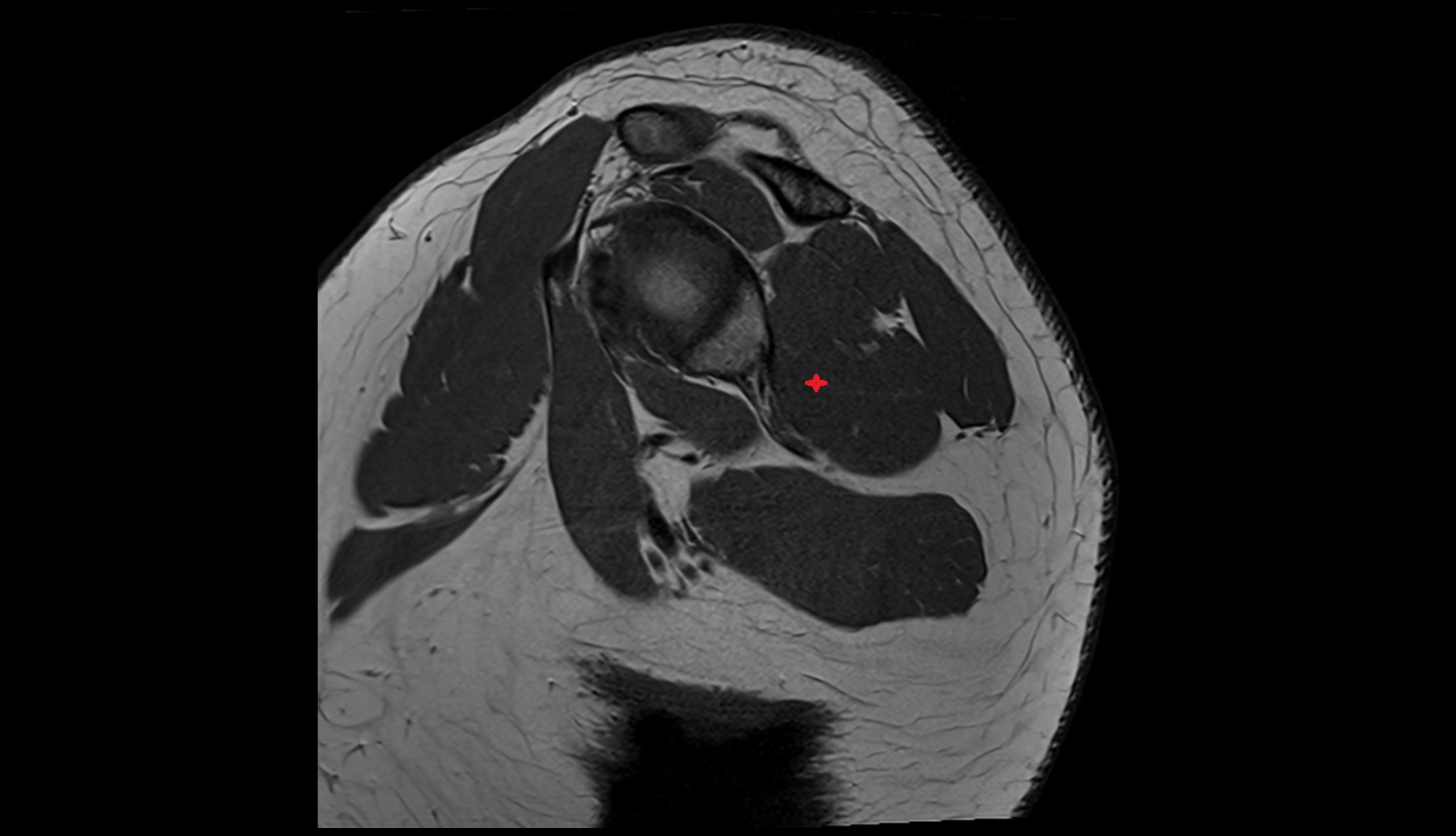 Teres minor muscle  anatomy MRI sag