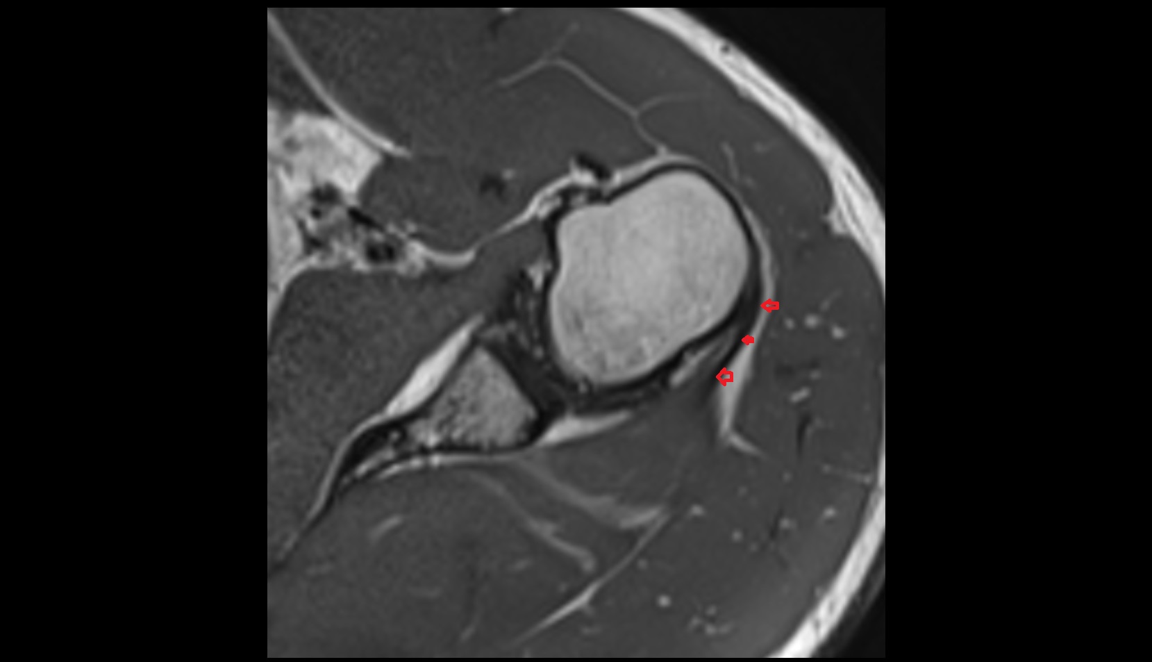 Teres minor tendon 3d mri 1mm image