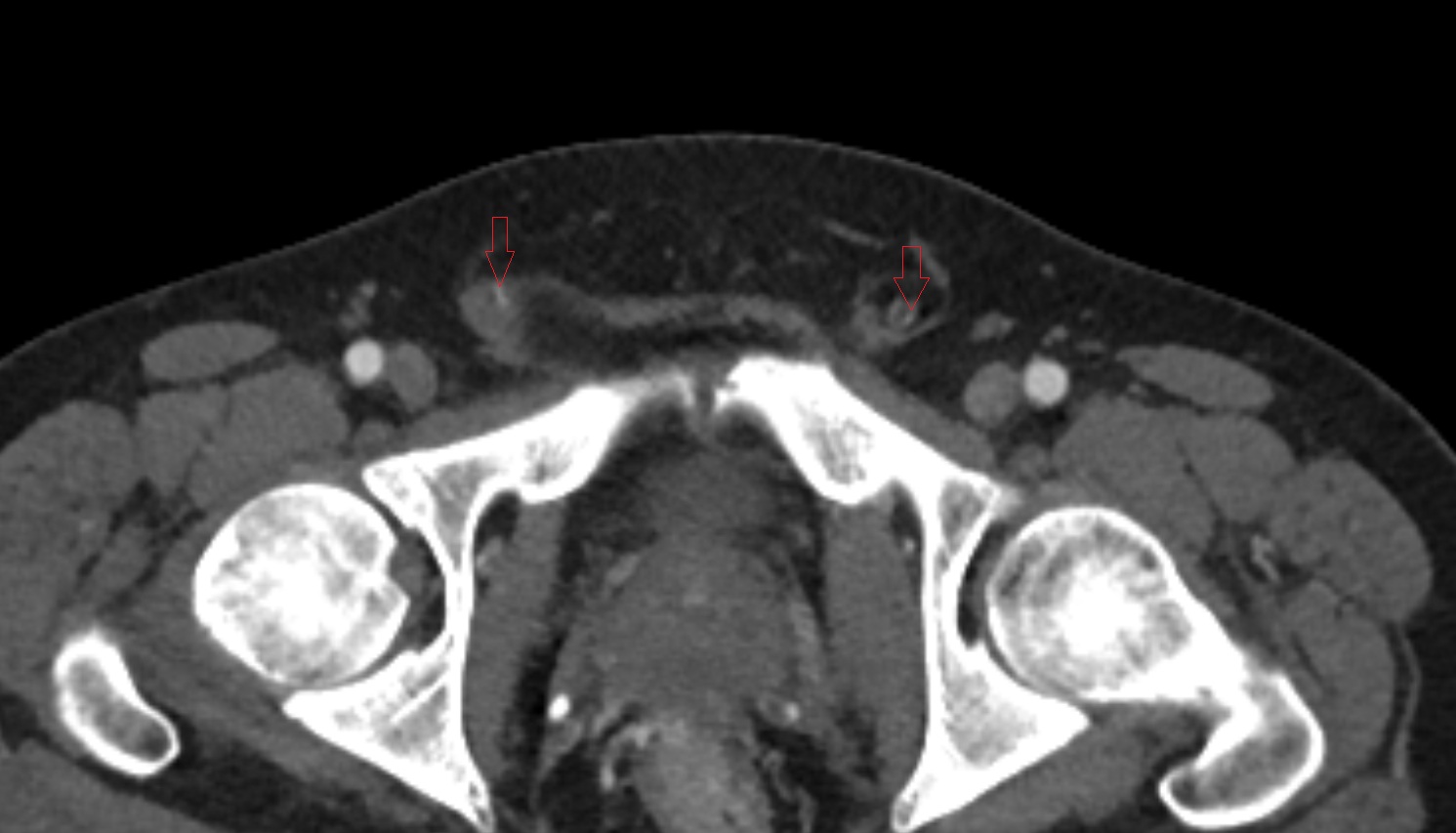 Testicular artery  CT axial  image   CT axial anatomy  image-img-00000-00000