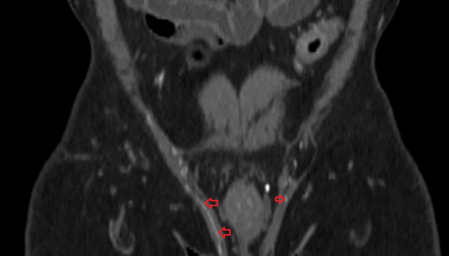 Testicular artery  CT coronal  image   CT axial anatomy  image-img-00000-00000