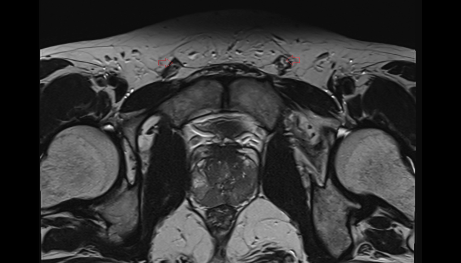 Testicular artery  mri axial  image   CT axial anatomy  image-img-00000-00000