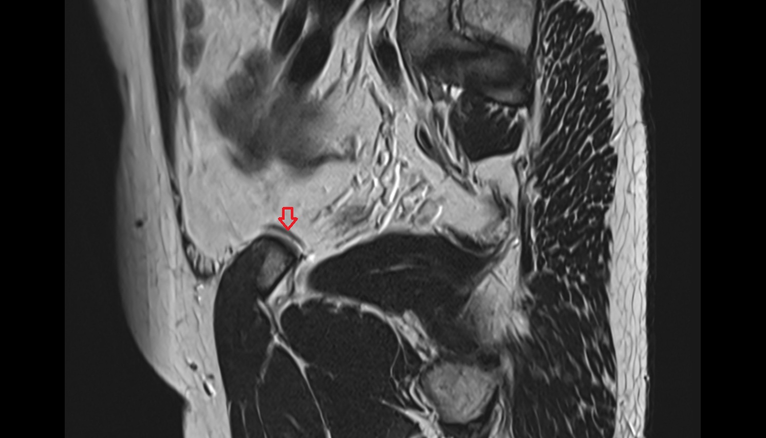 Testicular artery  mri sag  image   CT axial anatomy  image-img-00000-00000