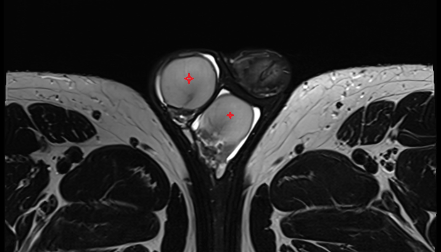 Testis  mri axial  anatomy  image-img-00000-00000