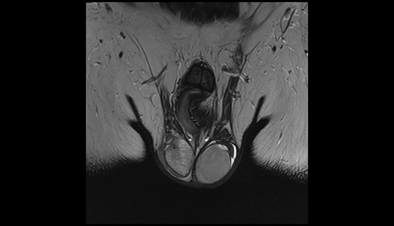 Testis mri coronal image