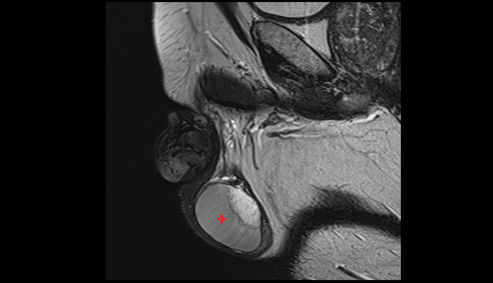 Testis sag mri image