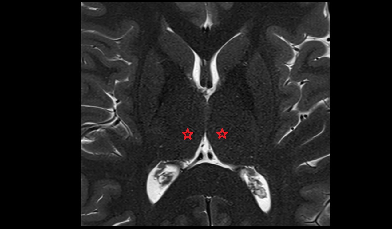 Thalamus mri 3t axial image