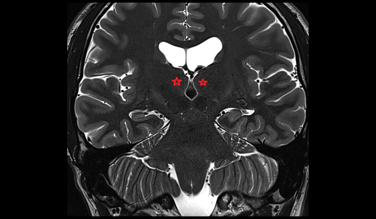 Thalamus mri 3t coronal image