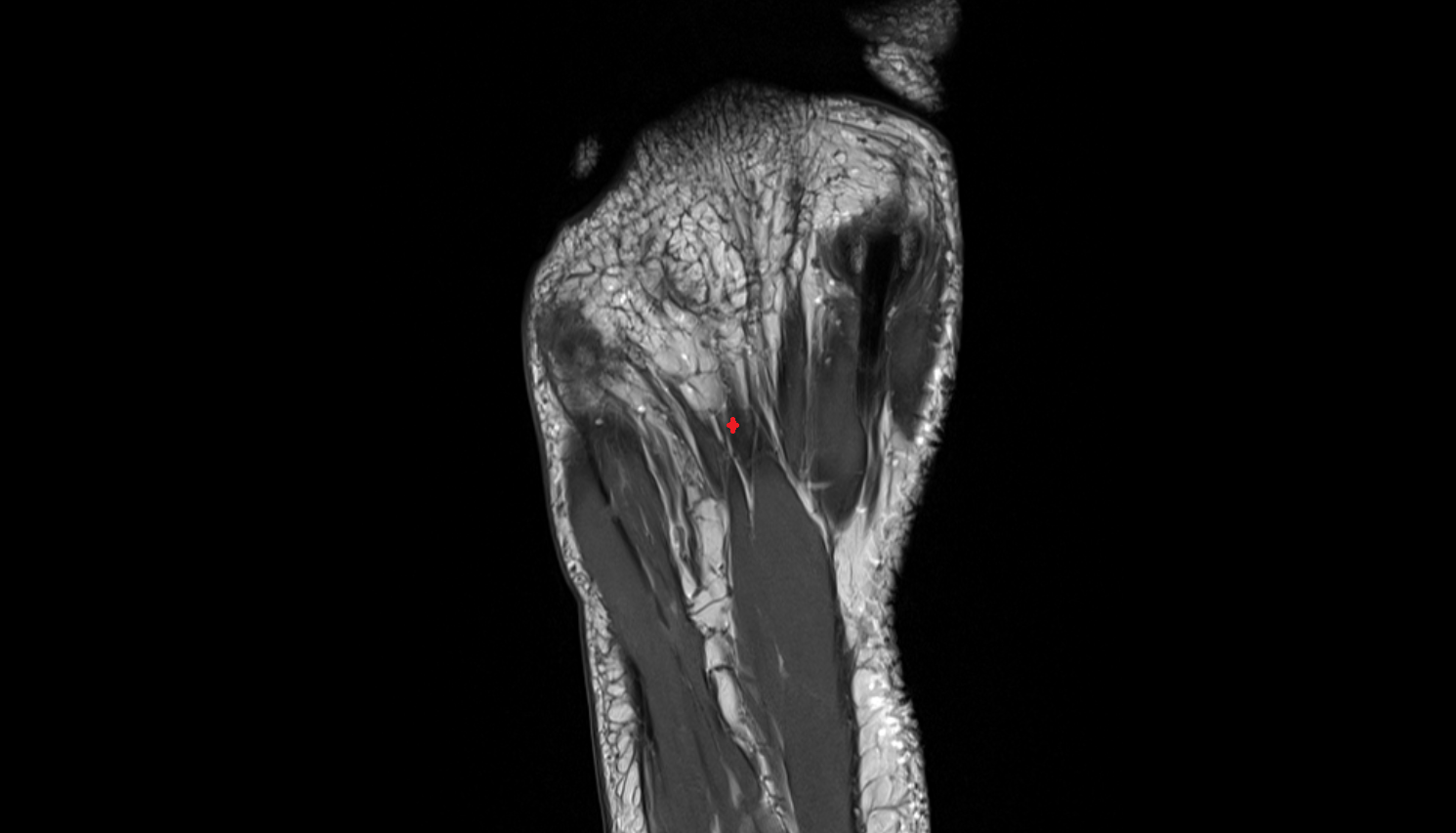 Third Lumbrical Muscle of the Foot  axial cross sectional anatomy 3T MRI AI enhanced radiology image-img-00000-00000