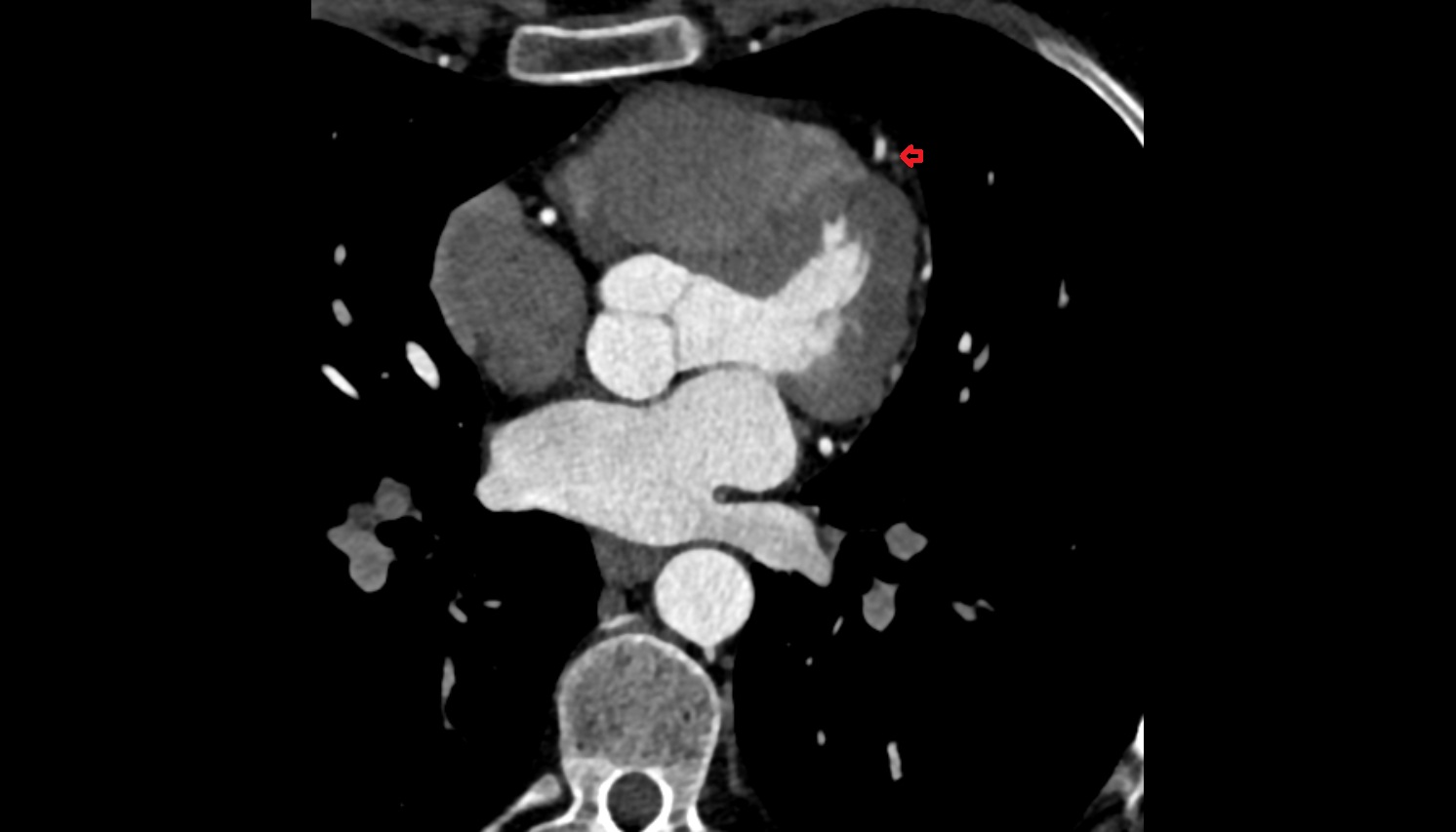 Third diagonal branch (D3) of LAD  anantomy  CT  axial image -img-00000-00000
