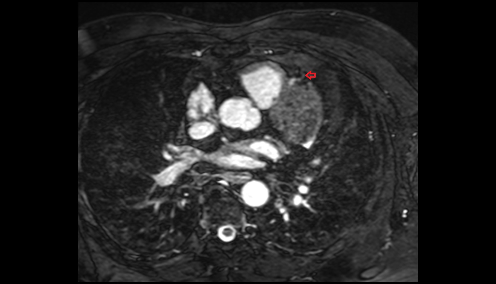 Third diagonal branch (D3) of LAD mri axial image