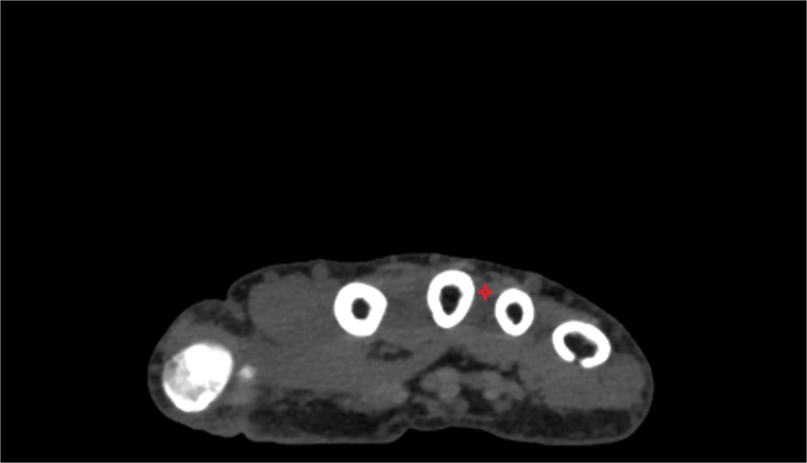 Third dorsal interosseous muscle ct axial image