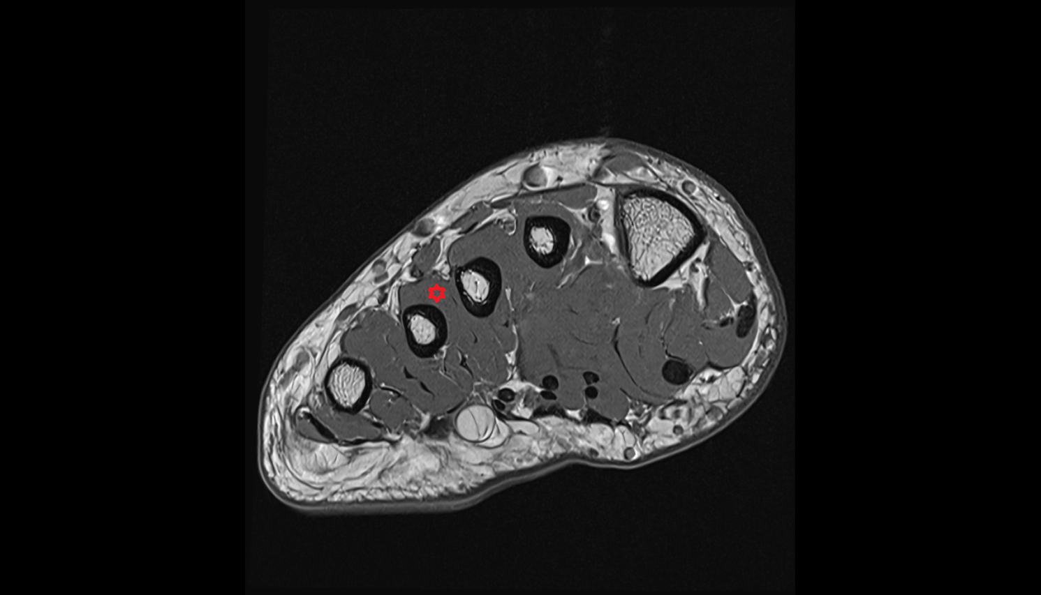 Third dorsal interosseous muscle of foot  muscle coronal cross sectional anatomy 3T MRI AI enhanced radiology image-img-00000-00000