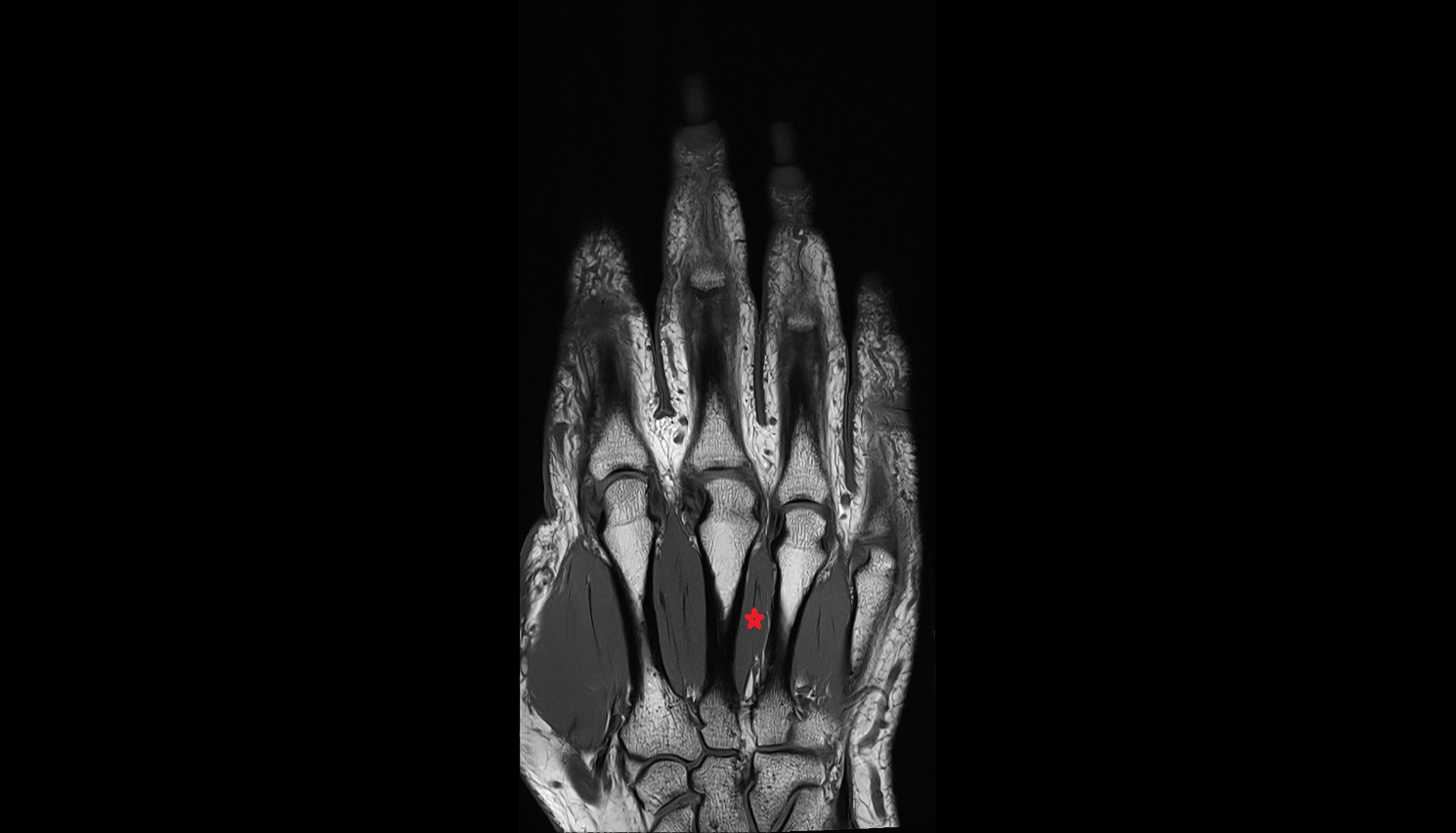 Third dorsal interosseous muscle of hand of hand coronal cross sectional anatomy 3T MRI AI enhanced radiology image-img-00000-00000