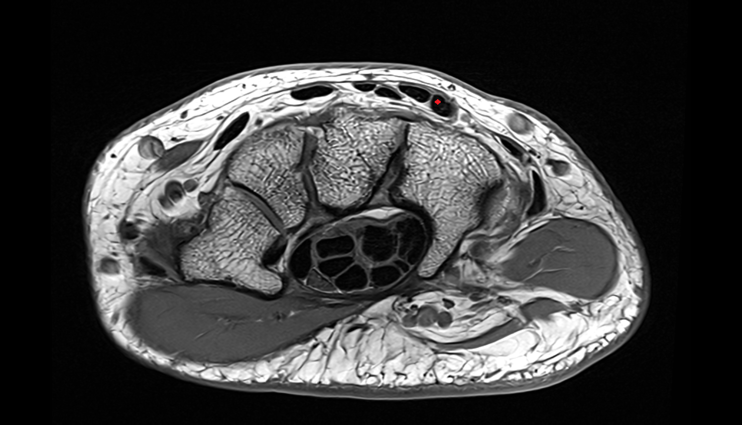Third extensor digitorum tendon (Extensor digitorum tendon to ring finger)  axial cross sectional anatomy 3T MRI AI enhanced radiology image-img-00000-00000