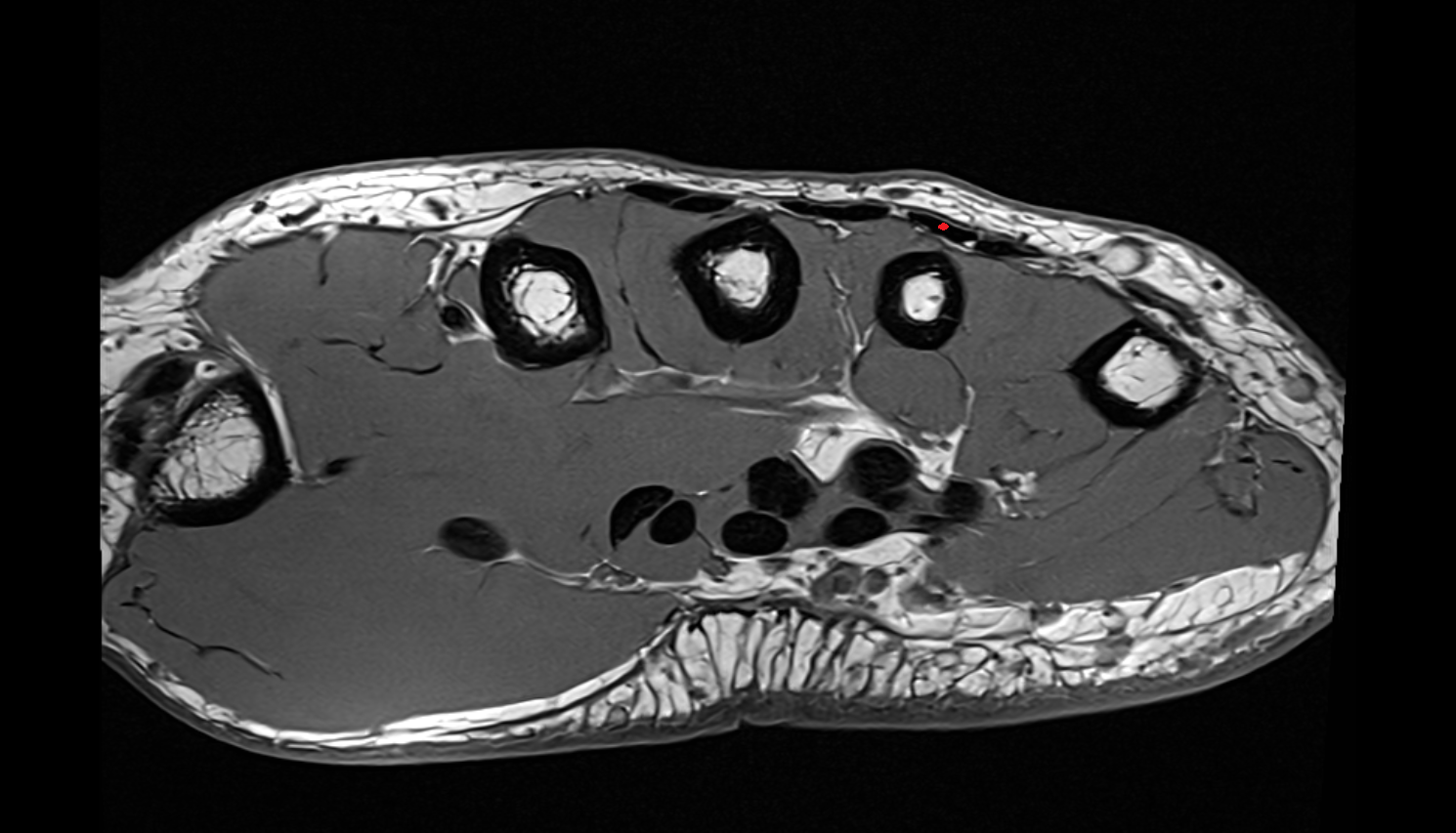 Third extensor digitorum tendon (Extensor digitorum tendon to ring finger)  axial cross sectional anatomy 3T MRI AI enhanced radiology image-img-00000-00000_00001