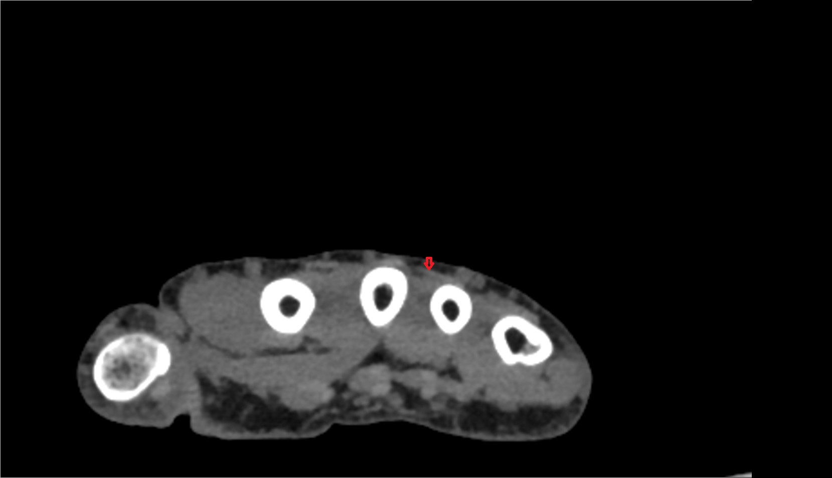 Third extensor digitorum tendon (Extensor digitorum tendon to ring finger) ct axial