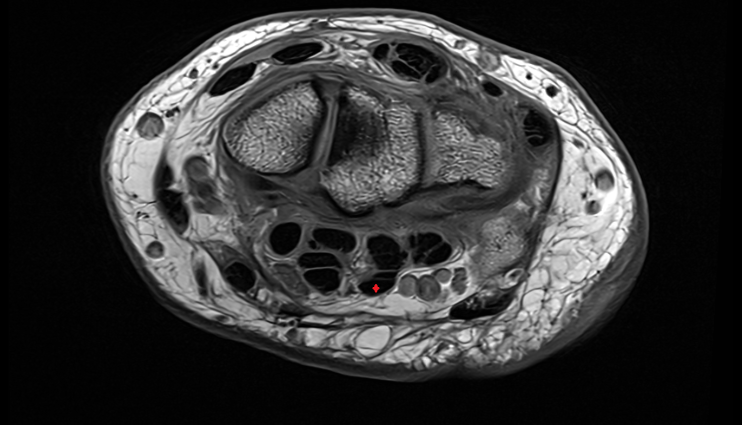 Third flexor digitorum superficialis tendon (ring) axial cross sectional anatomy 3T MRI AI enhanced radiology image-img-00000-00000_00001