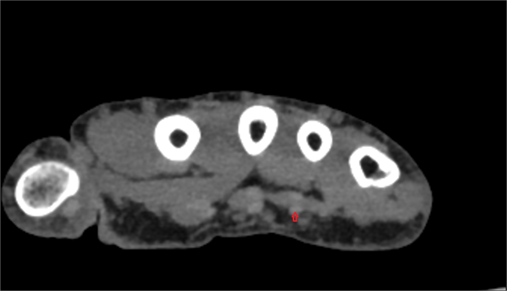 Third flexor digitorum superficialis tendon (ring) ct axial