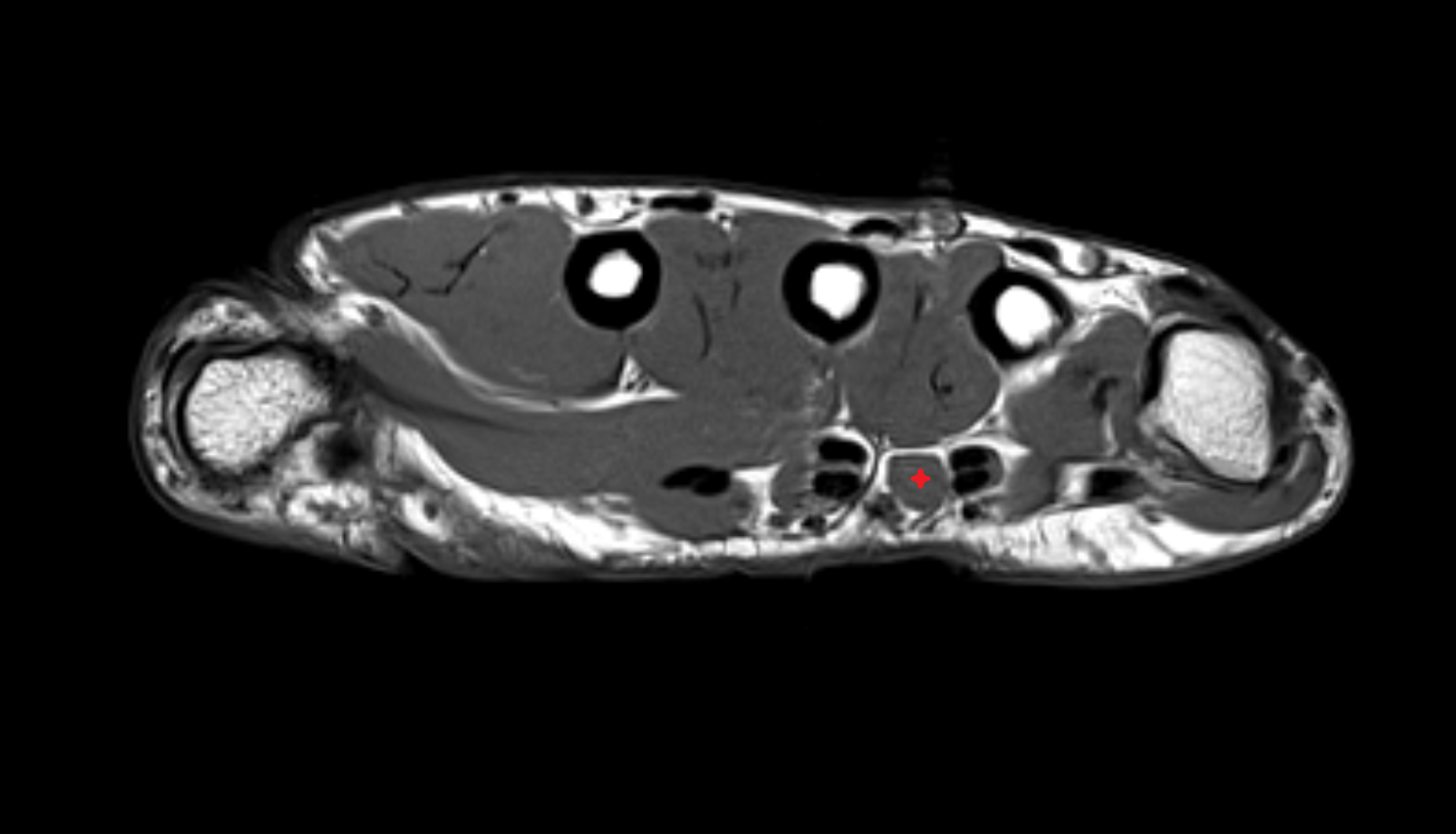 Third lumbrical muscle of hand of hand axial cross sectional anatomy 3T MRI AI enhanced radiology image-img-00000-00000_00001