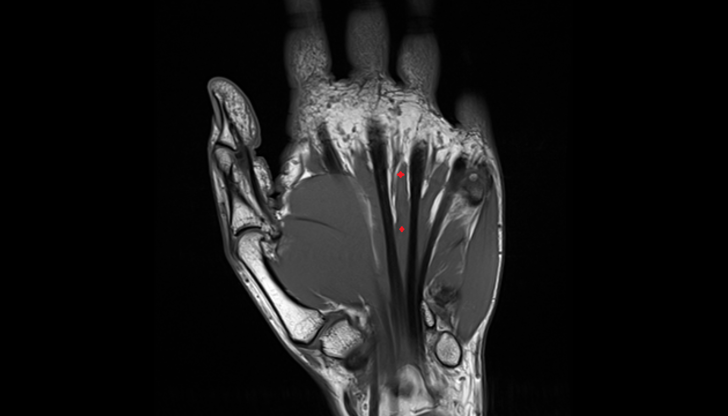 Third lumbrical  muscle of hand of hand coronal cross sectional anatomy 3T MRI AI enhanced radiology image-img-00000-00000