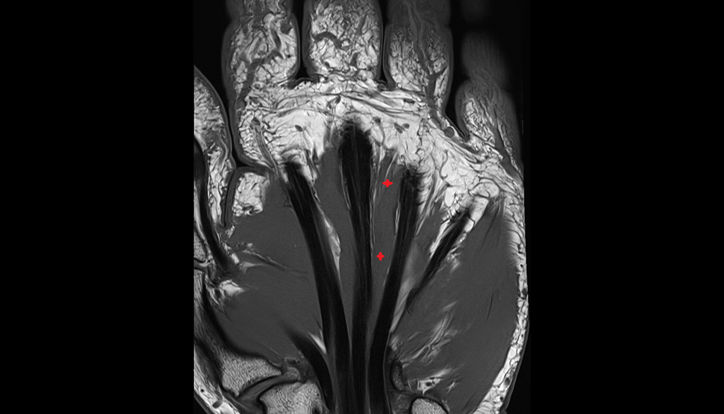 Third lumbrical  muscle of hand of hand coronal cross sectional anatomy 3T MRI AI enhanced radiology image-img-00000-00000_00001