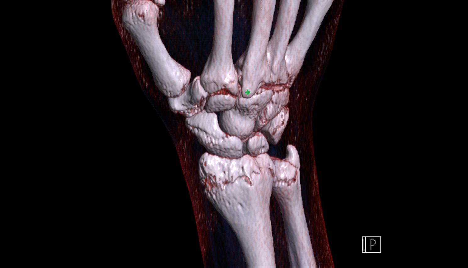 Third metacarpal styloid process  CT 3D VRT image -img-00000-00000