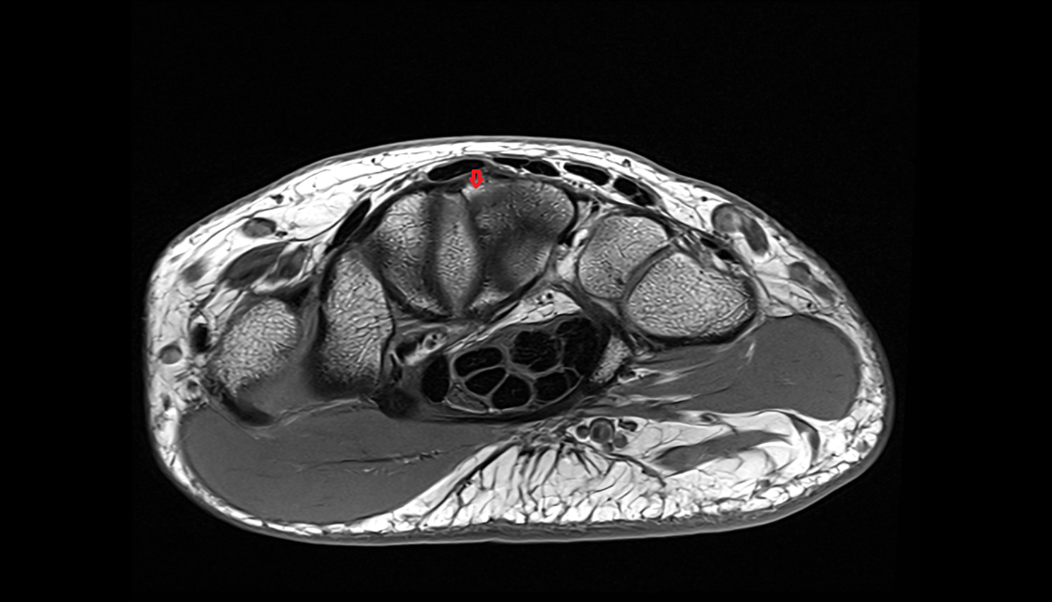 Third metacarpal styloid process axial cross sectional anatomy 3T MRI AI enhanced radiology image-img-00000-00000