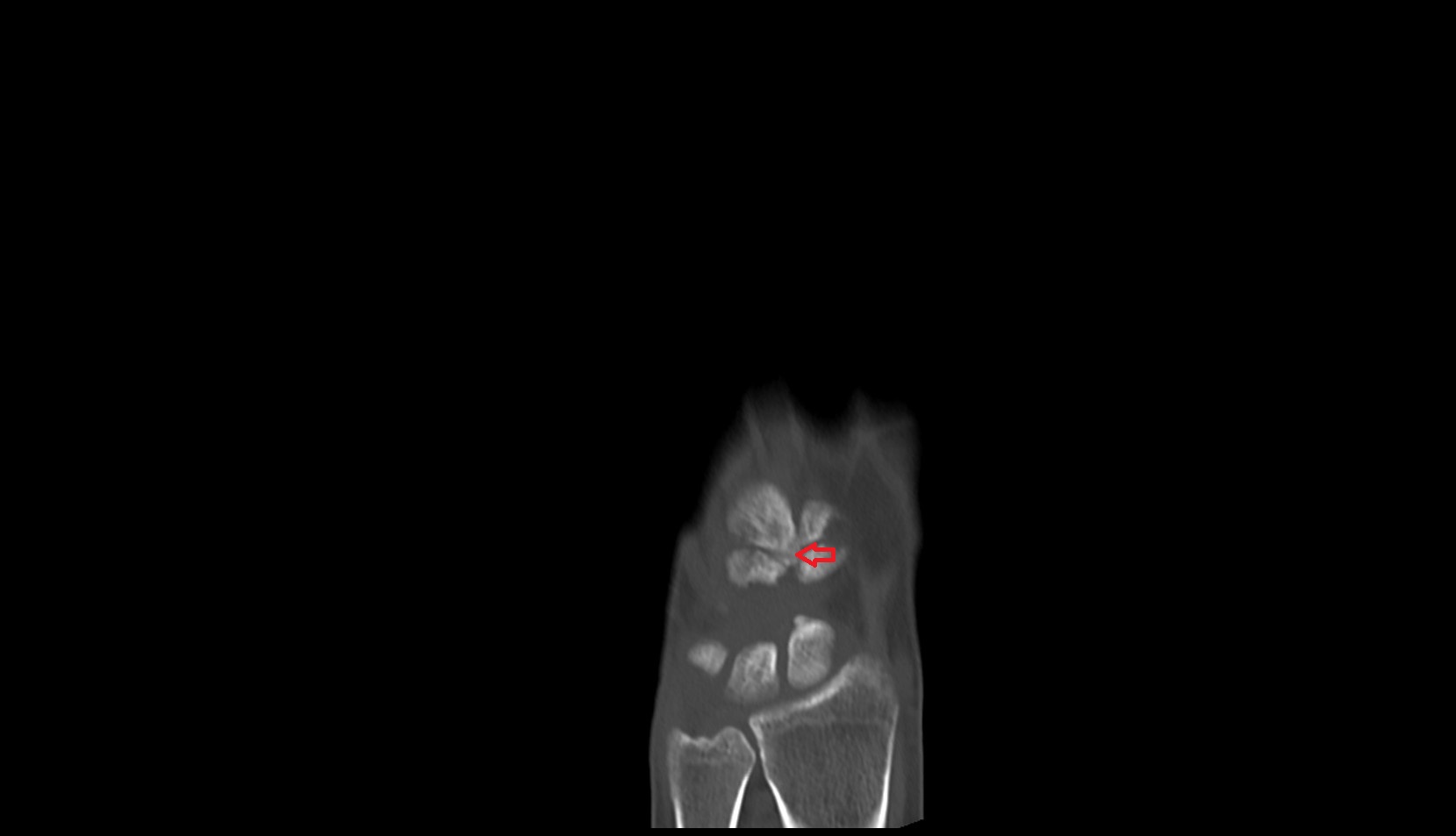 Third metacarpal styloid process coronal ct image