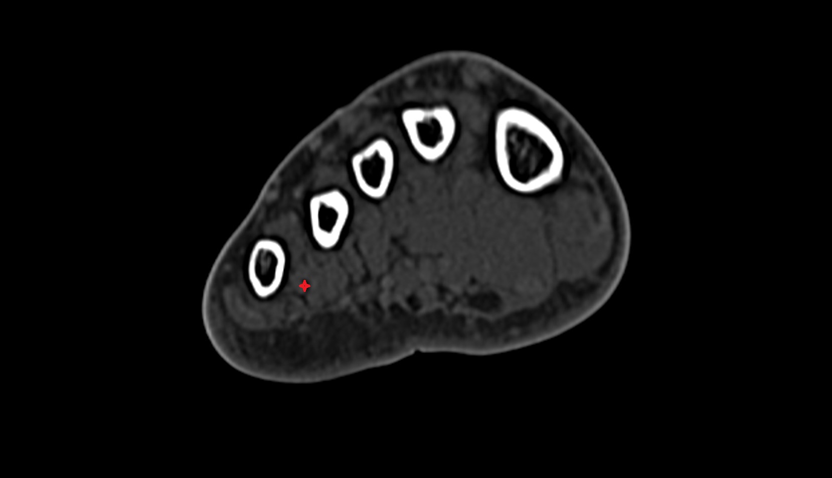 Third plantar interosseous muscle ct axial image