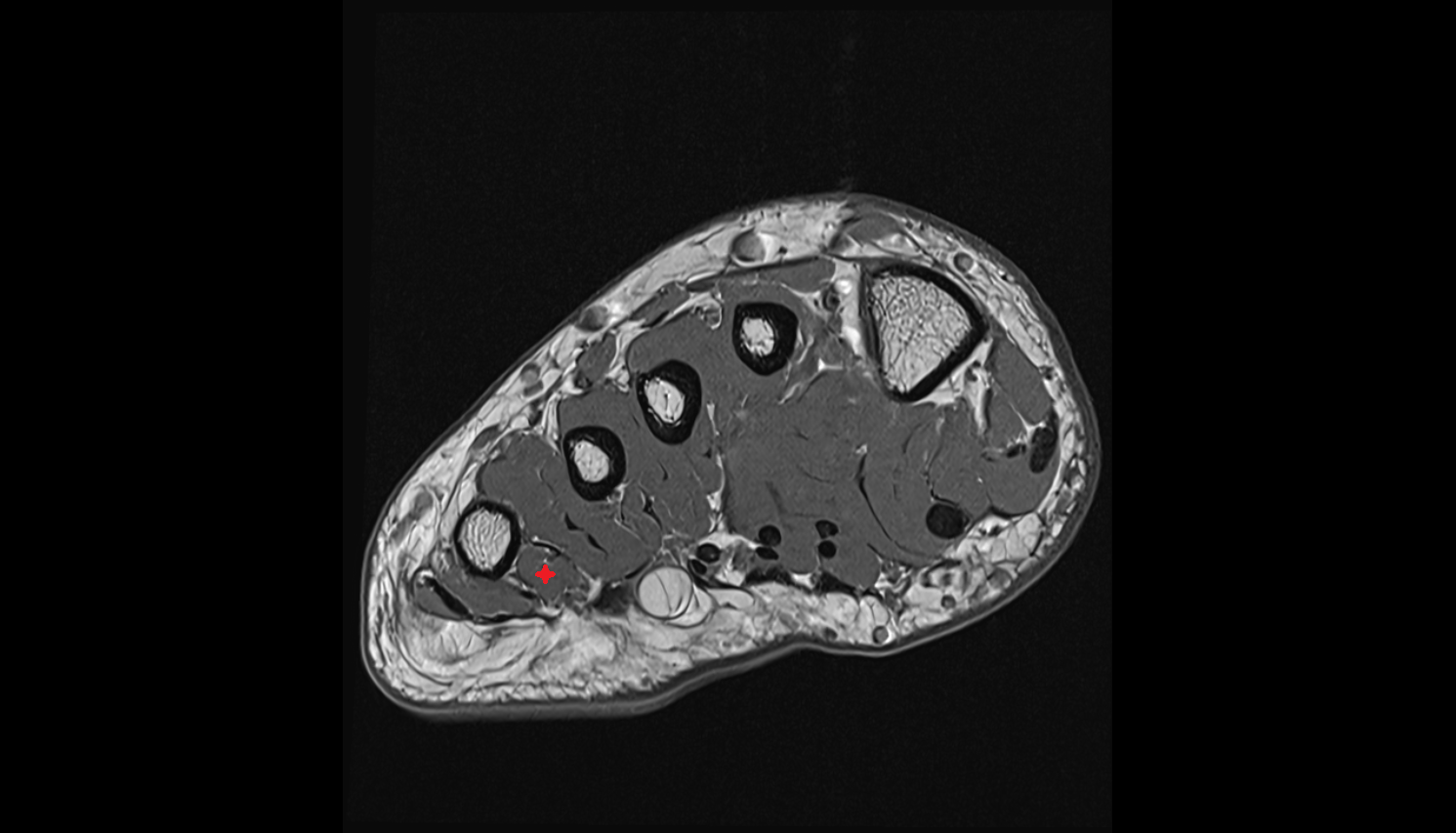 Third plantar interosseous muscle  of foot  axial cross sectional anatomy 3T MRI AI enhanced radiology image-img-00000-00000