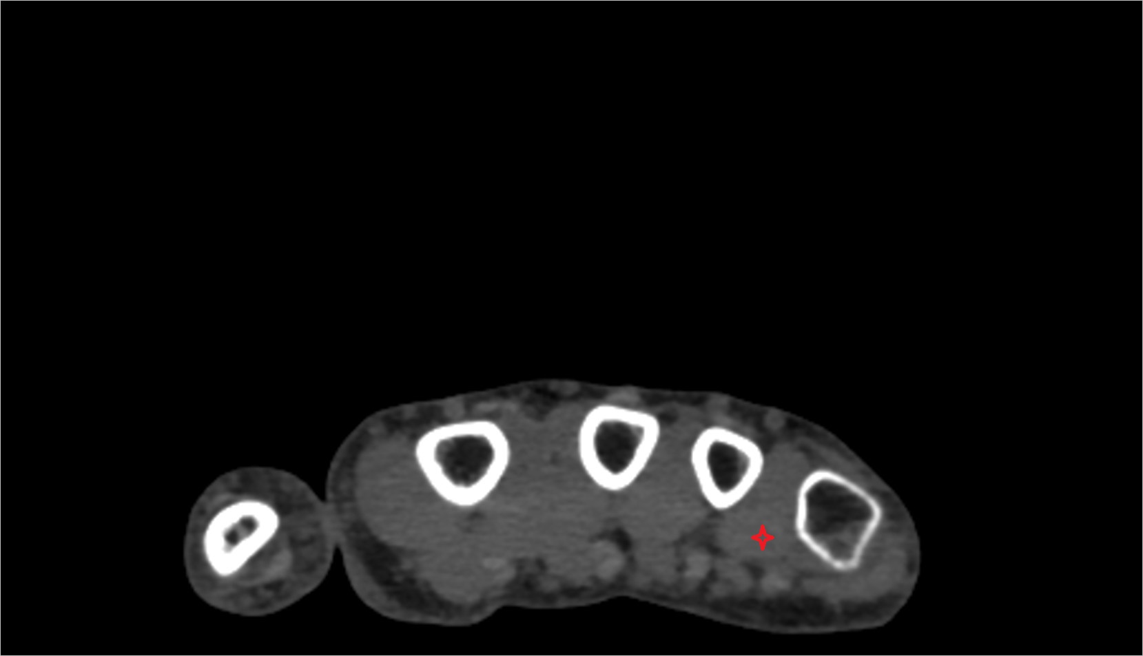 Third plantar (palmar) interosseous muscle ct axial image