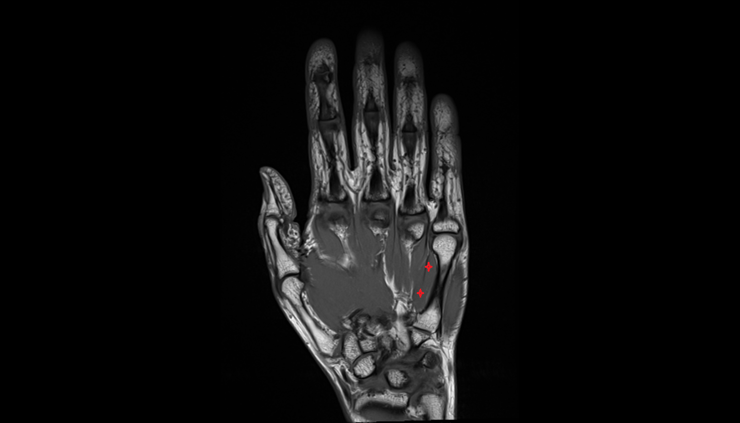 Third plantar (palmar) interosseous muscle of hand of hand axial cross sectional anatomy 3T MRI AI enhanced radiology image-img-00000-00000