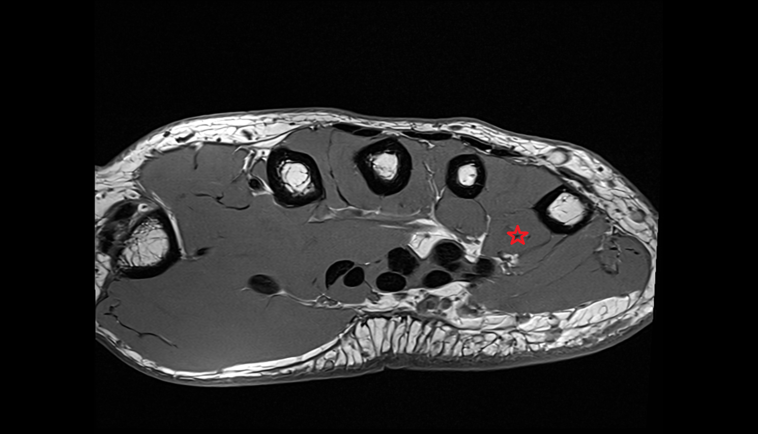 Third plantar (palmar) interosseous muscle of hand of hand axial cross sectional anatomy 3T MRI AI enhanced radiology image-img-00000-00000_00001