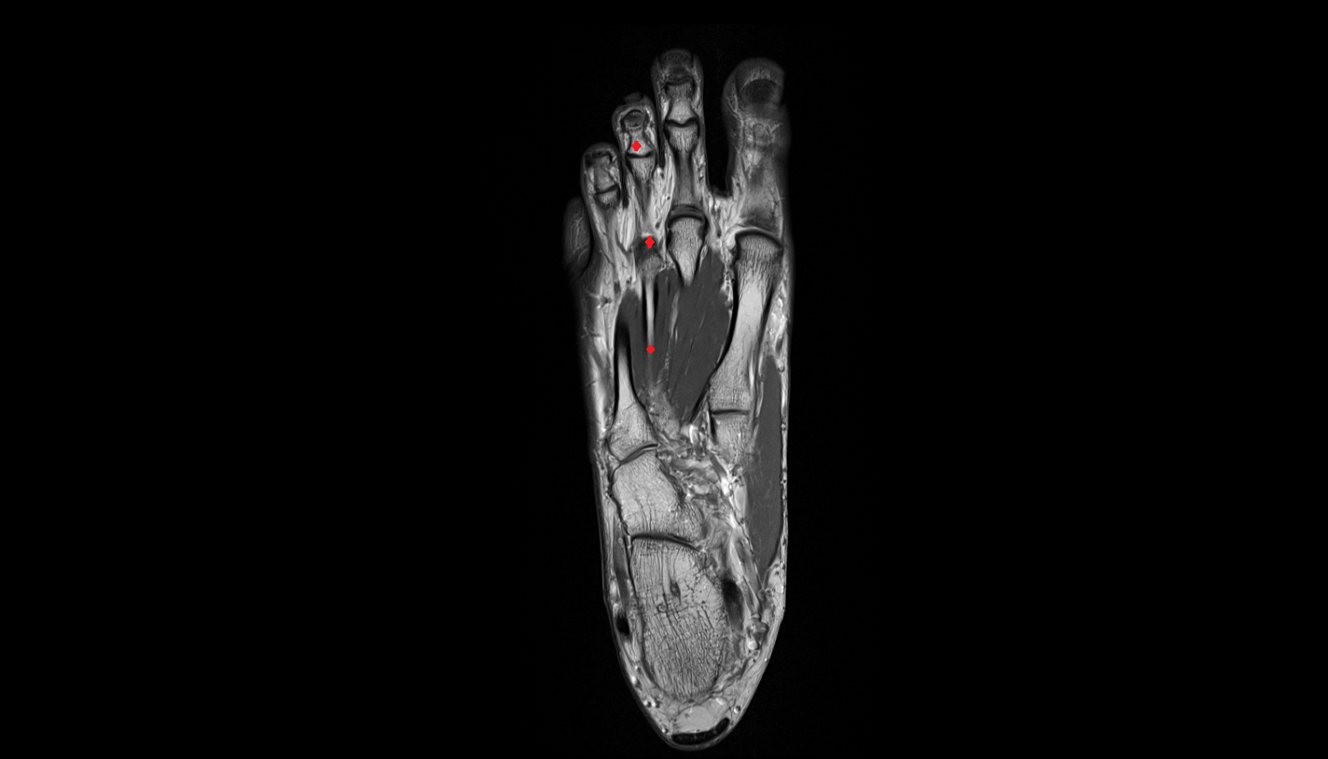 Third toe of foot axial cross sectional anatomy 3T MRI AI enhanced radiology image-img-00000-00000
