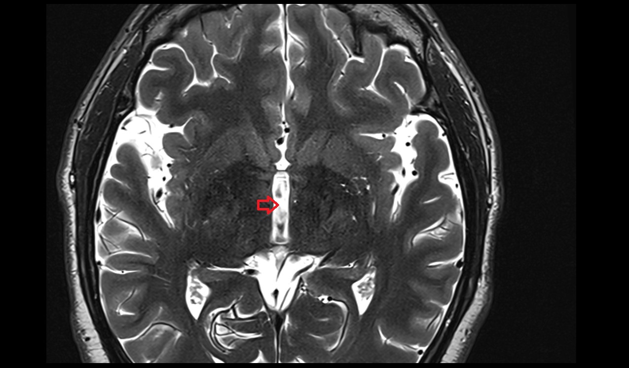 Third ventricle mri 3t axial image