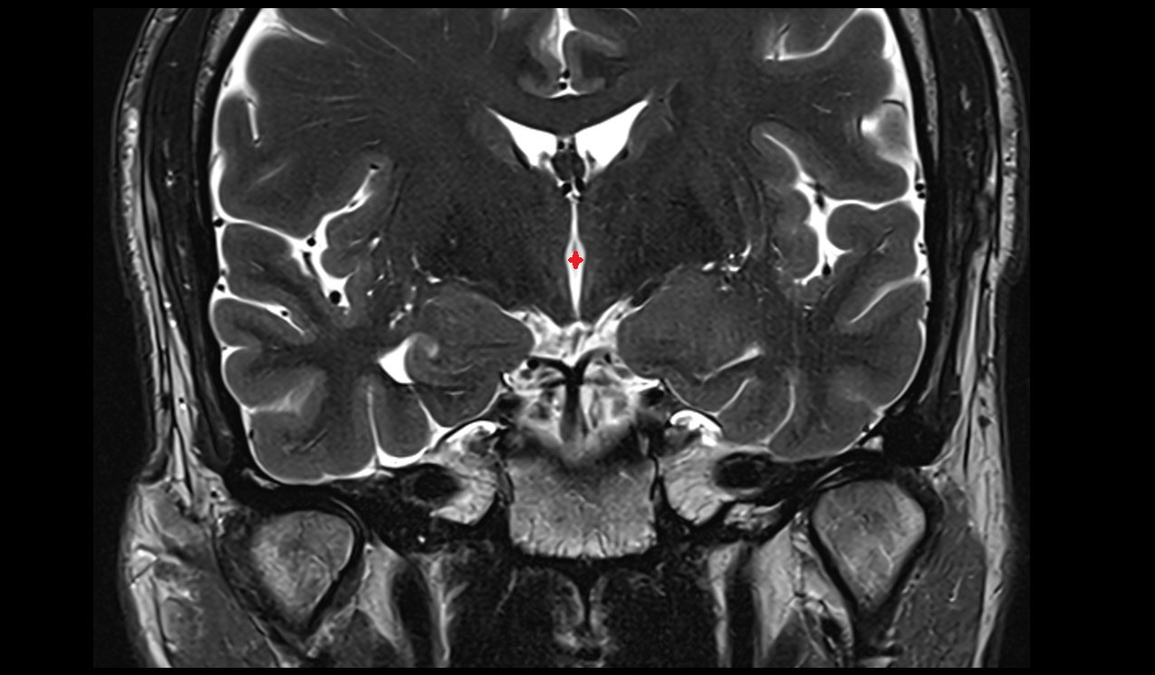 Third ventricle mri 3t coronal image
