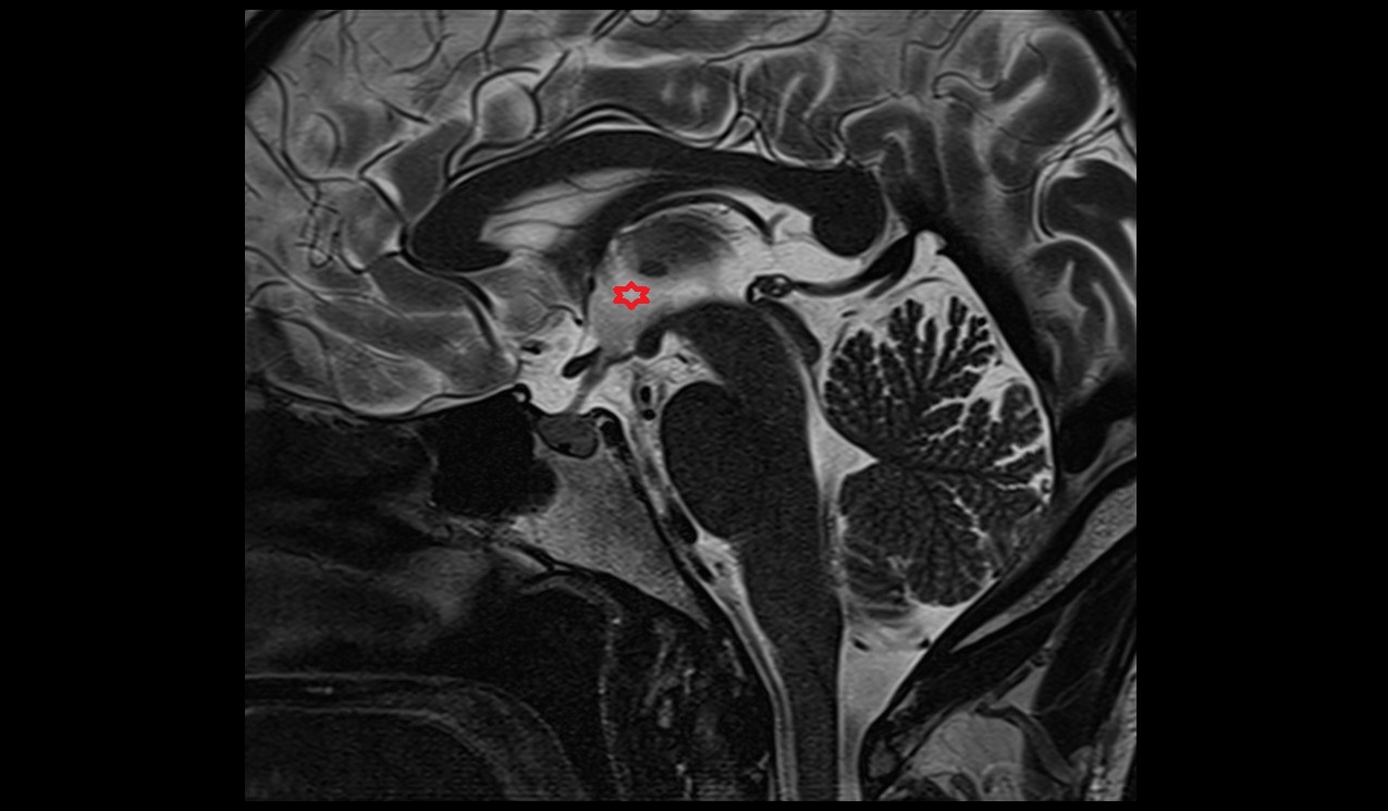 Third ventricle mri 3t sagittal  image