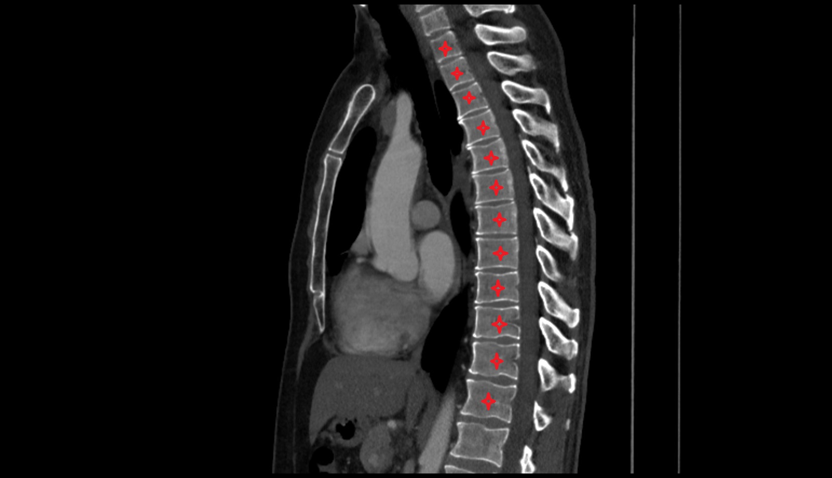 Thoracic Spine (T Spine) CT SAG IMAGE