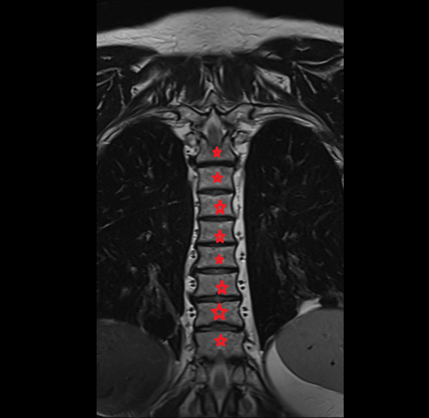 Thoracic Spine (T Spine) MRI   anatomy  Location and Imaging Appearance  -img-00000-00000