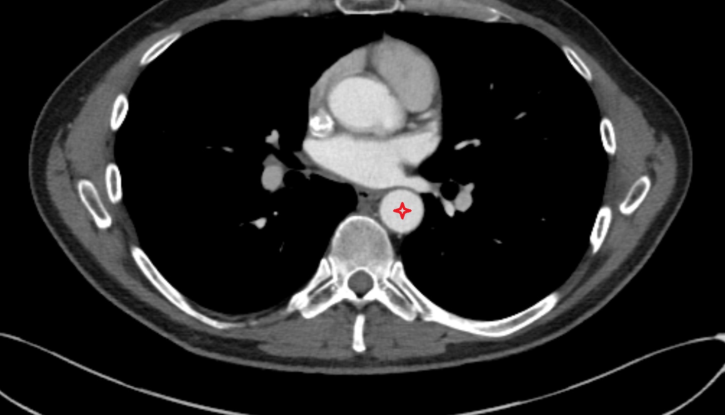 Thoracic aorta  ct axial  anatomy  image-img-00000-00000