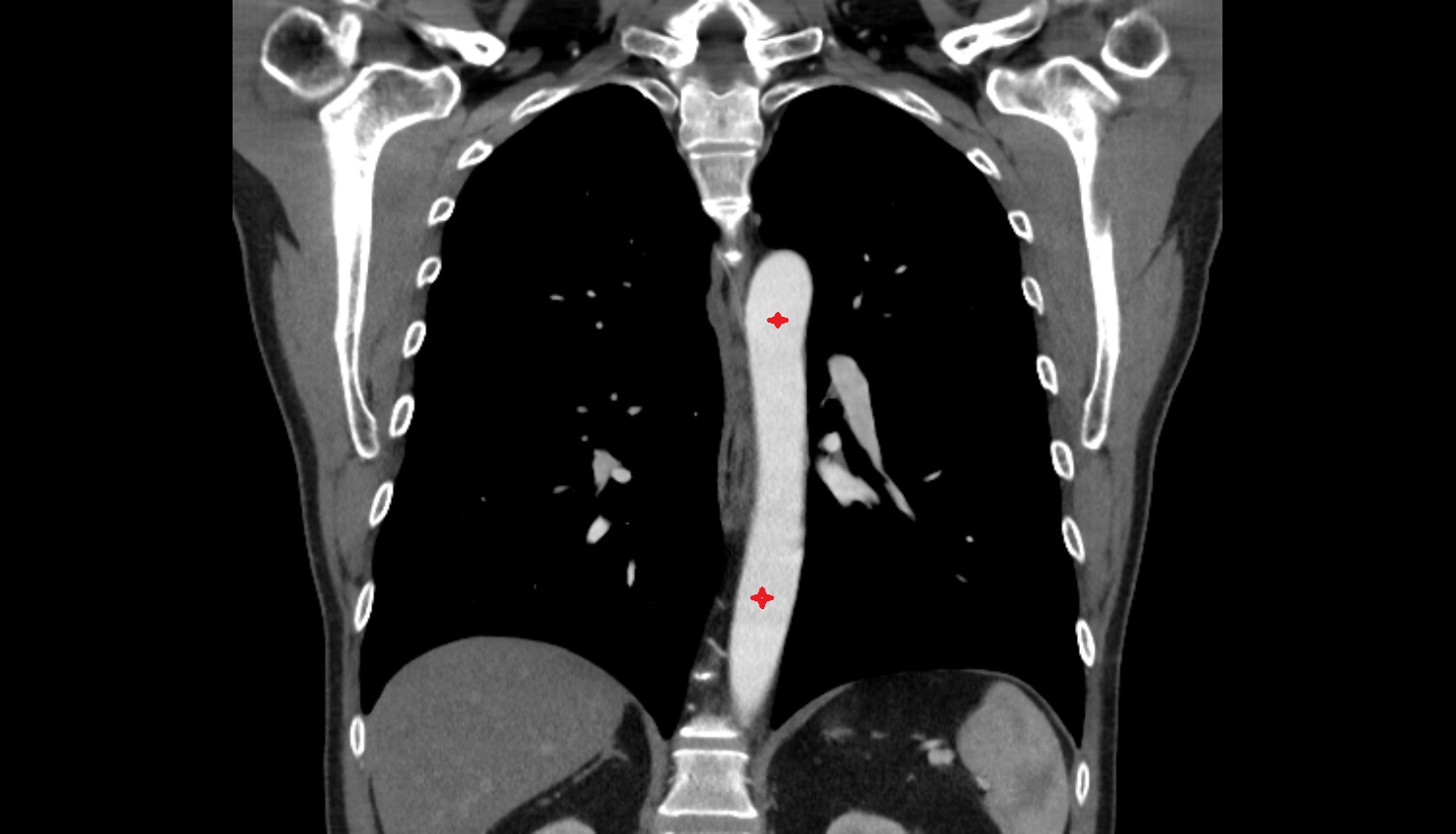 Thoracic aorta  ct coronal  anatomy  image-img-00000-00000